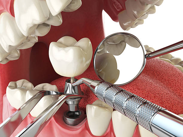 Best Emergency Wisdom Teeth Removal in Brusly, LA